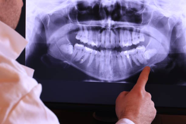 Best Emergency Wisdom Tooth Extraction in Dousman, WI